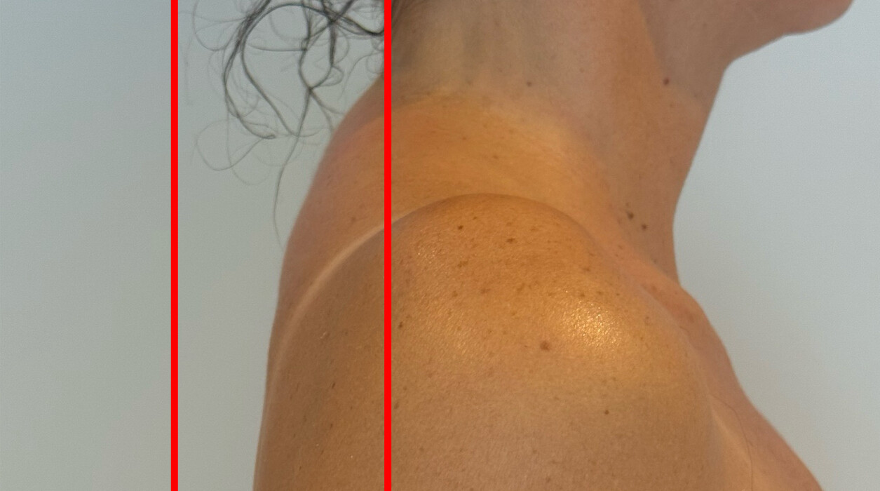 Tension Relief treatment result