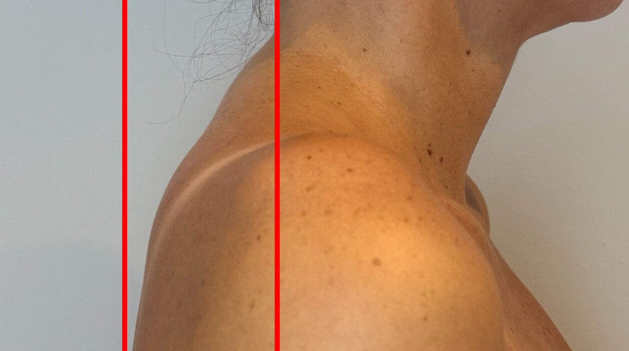 Tension Relief treatment